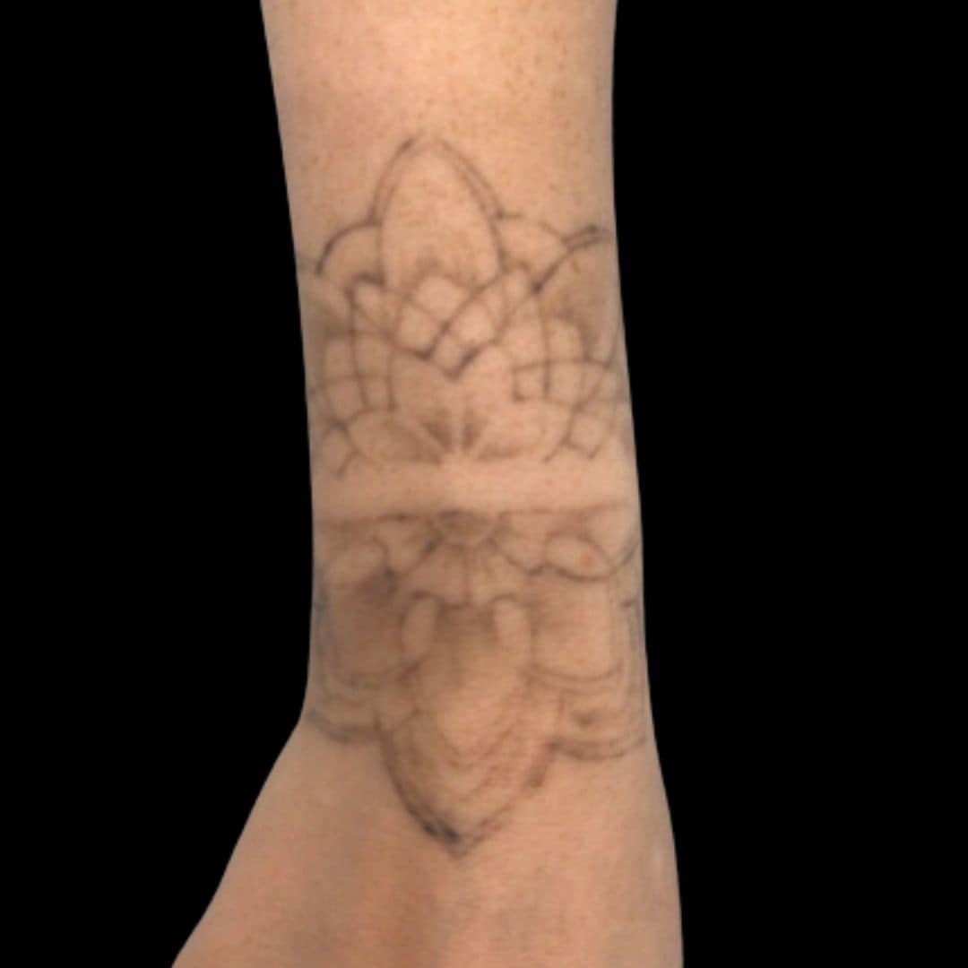 Laser Tattoo Removal After 3 Treatments Brooke