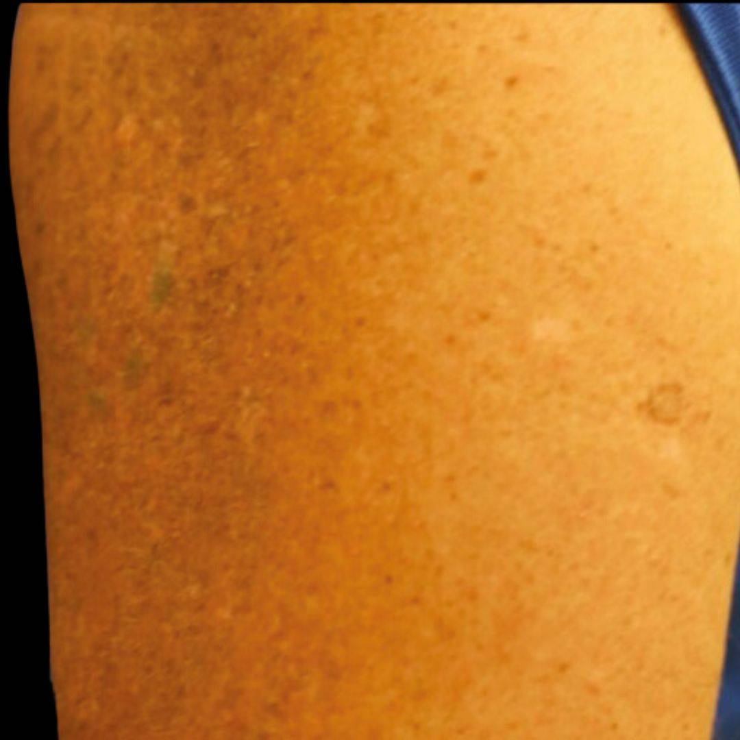 Laser Tattoo Removal After 5 Treatments Charlie