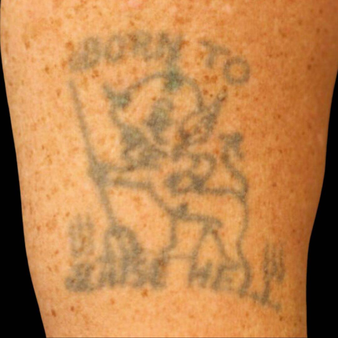Laser Tattoo Removal Shoulder Tattoo Before Charlie