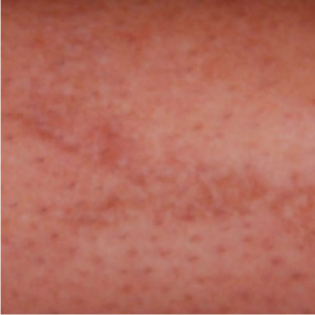 Laser Tattoo Removal Small Tattoo After 4 Treatments Jimmy