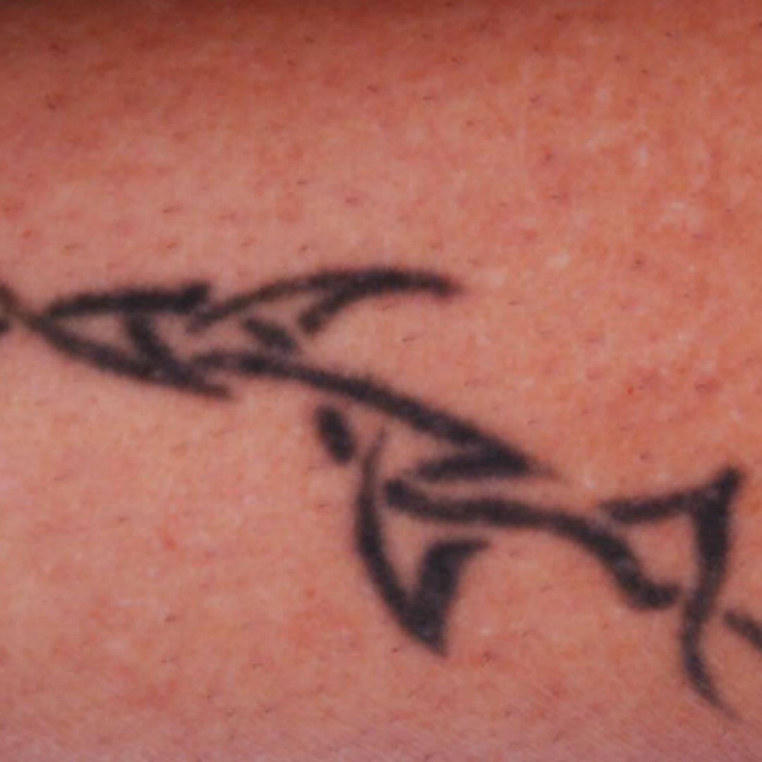 Laser Tattoo Removal Small Tattoo Before Treatment Jimmy